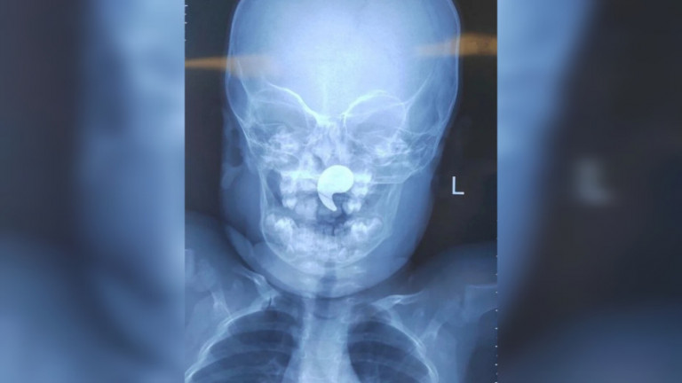 магнит в носу